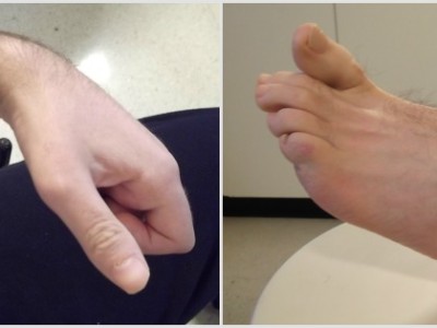 Toxina botulínica. ¿Pero esto no es un veneno? Toxina botulínica. ¿Pero esto no es un veneno?