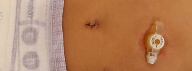 PEGa duten haurrek elikagaiei dieten abertsioaren tratamendu prebentiboa PEGa duten haurrek elikagaiei dieten abertsioaren tratamendu prebentiboa