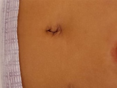 PEGa duten haurrek elikagaiei dieten abertsioaren tratamendu prebentiboa PEGa duten haurrek elikagaiei dieten abertsioaren tratamendu prebentiboa