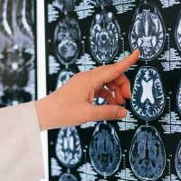 Un sanitario señala una imagen de una tomografía cerebral