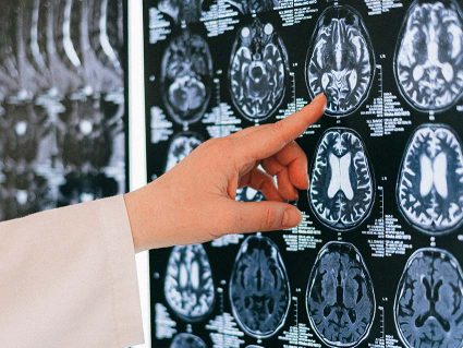 Long covida eta bere ondorioak funtzionamendu kognitiboan Un sanitario señala una imagen de una tomografía cerebral